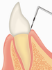 歯周ポケット検査